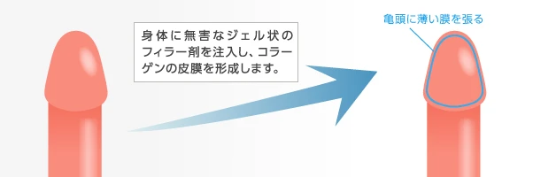 過敏性早漏の治療